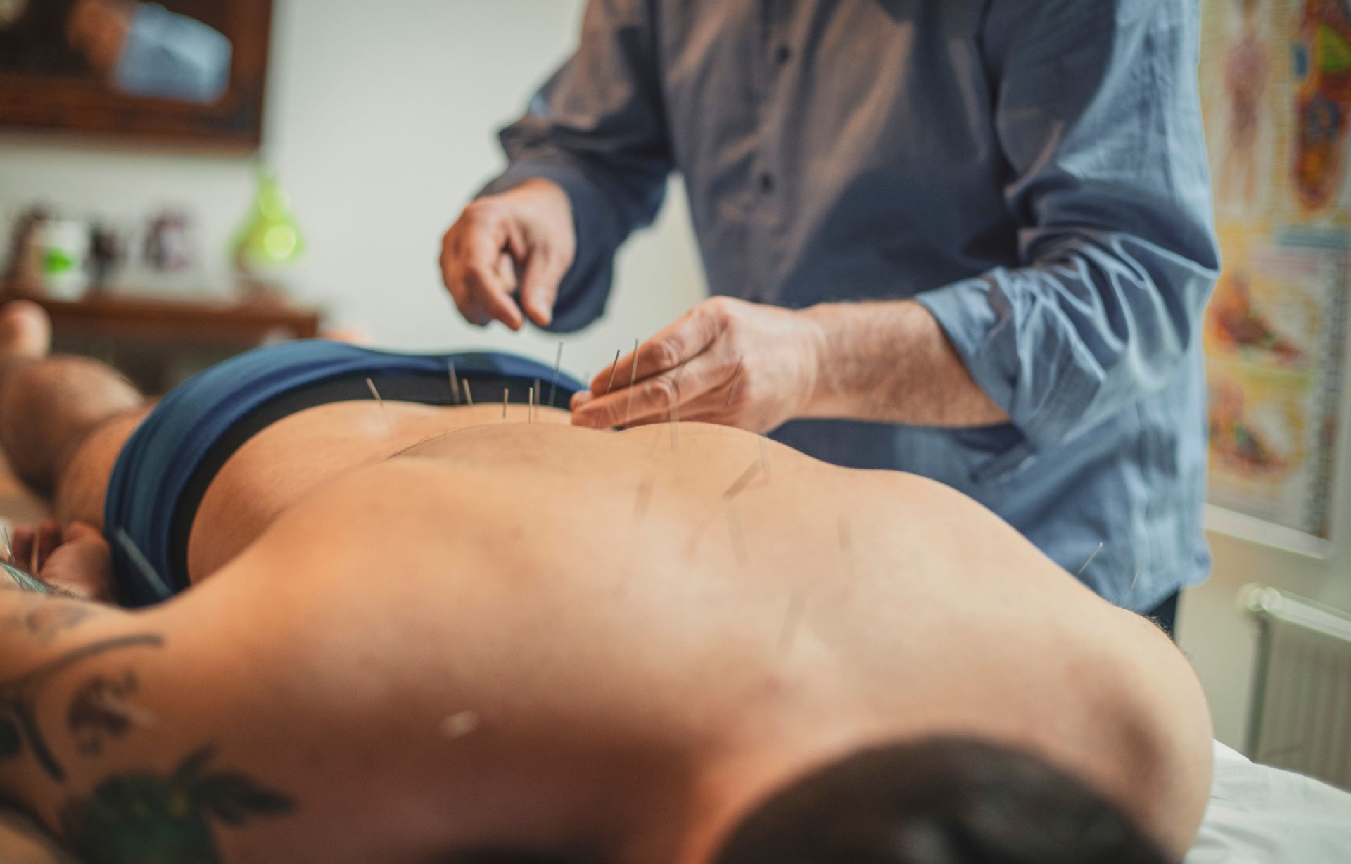 Acupuncture & Dry Needling